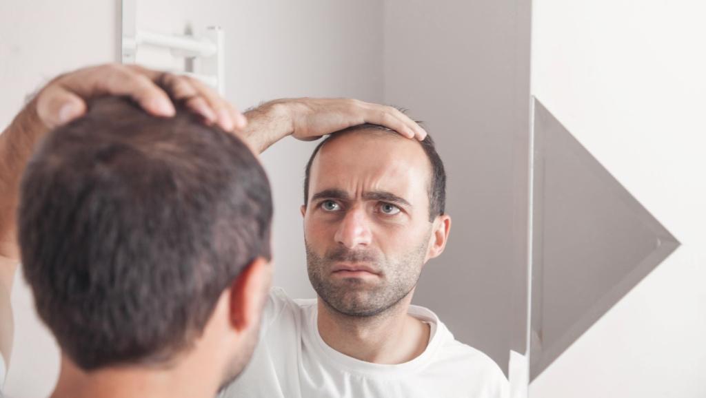 Выпадение волос у мужчин: симптомы, признаки АГА