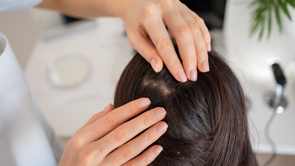 Виды перхоти. Как определить свой тип